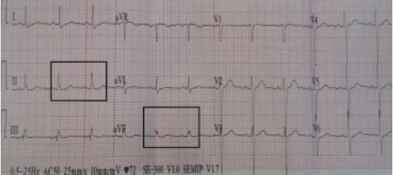 Eyuboglu-J-Am-Soc-Hypertens-2017